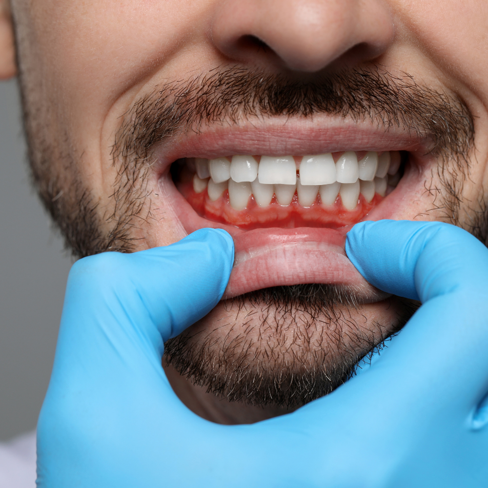 Hands with gloves holding bottom lip down to show patients swollen gums